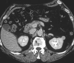 1 Cm Renal Cancer (left) - CTisus CT Scan