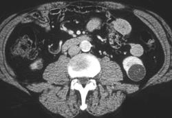 Renal Cyst (bosniak I) - CTisus CT Scan