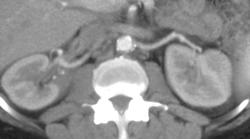 Calcification at Origin of Left Renal Artery - CTisus CT Scan