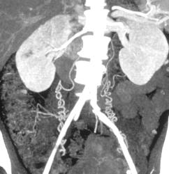 Unusual Retroperitoneal Collaterals - CTisus CT Scan