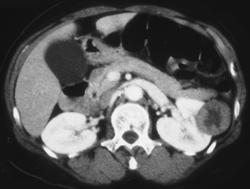 Renal Cell Carcinoma - CTisus CT Scan