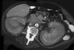 Renal Lymphoma - CTisus CT Scan