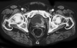 Bladder Cancer - CTisus CT Scan