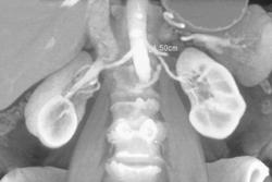 Retroaortic Renal Vein - CTisus CT Scan