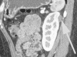 Small Bosniak Ii- Iii Cyst - CTisus CT Scan