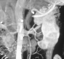 Parapelvic Cysts - CTisus CT Scan