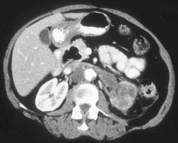 Transitional Cell Carcinoma With Renal Vein Involvement - CTisus CT Scan