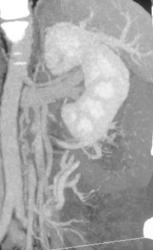 Incredible Vessels Around Left Renal Hilum- at Surgery They Fell Apart - CTisus CT Scan