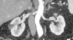 Bosniak Ii Cyst - CTisus CT Scan