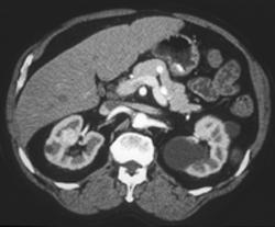 Renal Cysts on Left & 1cm Hypervascular Renal Cell Carcinoma on the Right Side - CTisus CT Scan