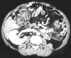 Retroperitoneal Fibrosis - CTisus CT Scan