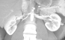 Prehilar Branching of the Right Renal Artery - CTisus CT Scan