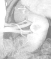 Prehilar Branching of the Left Renal Artery - CTisus CT Scan