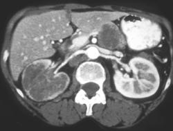 Metastasis to the Right Kidney & Pancreas - CTisus CT Scan