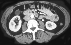 Prominent Left Gonadal Vein - CTisus CT Scan