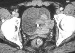 Bladder Cancer Invading Region of Trigone - CTisus CT Scan