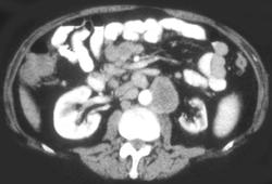 Seminoma With Adenopathy. Small Left Kidney - CTisus CT Scan