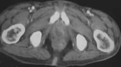 Renal Abscess & Prostate Abscess - CTisus CT Scan