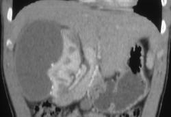 Page Kidney - CTisus CT Scan