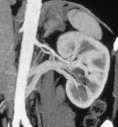 Retroaortic Left Renal Vein - Kidney Case Studies - CTisus CT Scanning