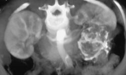 Calcified Renal Carcinoma - CTisus CT Scan