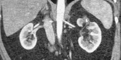 Renal Infarct - Old - CTisus CT Scan