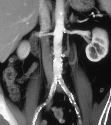 Calcifications in Renal Aa. & Aorta in Potential Renal Donor - CTisus CT Scan