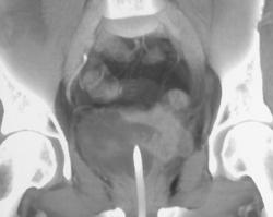 Bladder Cancer in 3D - CTisus CT Scan