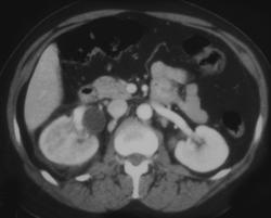 Right Hydronephrosis - CTisus CT Scan