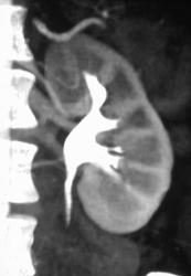 Normal 3D of Renal Pelvis - CTisus CT Scan