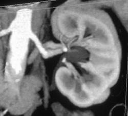 Normal MIP & VRT of Kidney - CTisus CT Scan