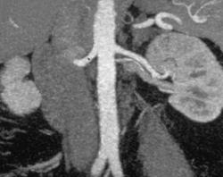 2 Left Renal Arteries - CTisus CT Scan