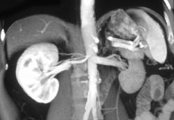 Compound Right Renal Artery - CTisus CT Scan