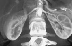 Prehilar Branching of Left Renal Aa. - CTisus CT Scan