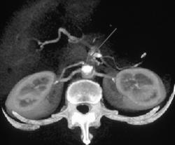 Small 2nd Right Renal Aa. - CTisus CT Scan