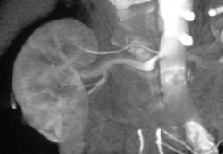 Minimal Stenosis at Origin of Right Renal Artery - CTisus CT Scan