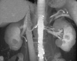 Plaque on Right Renal Artery - CTisus CT Scan