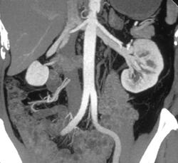 Normal Renal Vein Looks Retroaortic on MIP Image - CTisus CT Scan