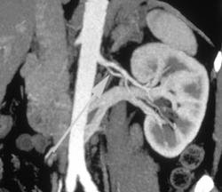 Prehilar Renal Aa. & Retroaortic Renal Vein - CTisus CT Scan