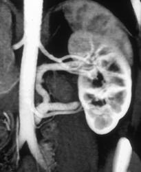 Duplicated Left Renal Aa. & Veins - CTisus CT Scan