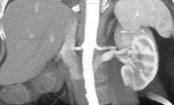 Retroaortic Renal Artery - CTisus CT Scan