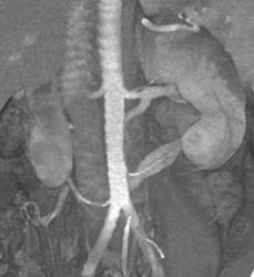 2 Left Renal Arteries and Lower Pole Retro-aortic Left Renal Vein - CTisus CT Scan