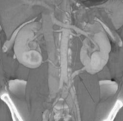 Unusual Left Lower Pole Renal Vein Arises Off Left Common Iliac Vein - CTisus CT Scan