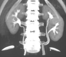 3D Urography of Duplicated Left Collecting System - CTisus CT Scan