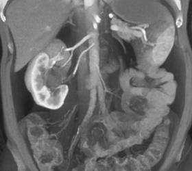 Solitary Right Kidney With 2 Renal Arteries - CTisus CT Scan