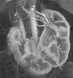 Horseshoe Kidney - CTisus CT Scan