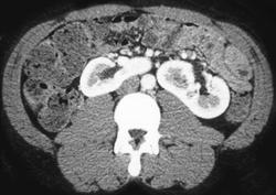 Horseshoe Kidney With A Right Renal Cyst - CTisus CT Scan