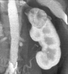 Renal Cell Carcinoma - CTisus CT Scan