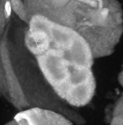 Renal Cell Carcinoma for Partial Nephrectomy - CTisus CT Scan