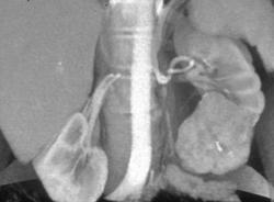 Renal Cell Carcinoma - CTisus CT Scan